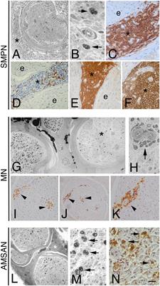 Clinical and pathological findings in neurolymphomatosis: Preliminary association with gene expression profiles in sural nerves